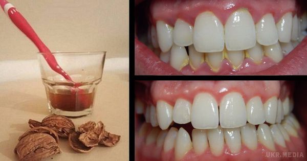 Видалення зубного каменю в домашніх умовах. Допоможе шкаралупа волоського горіха.
