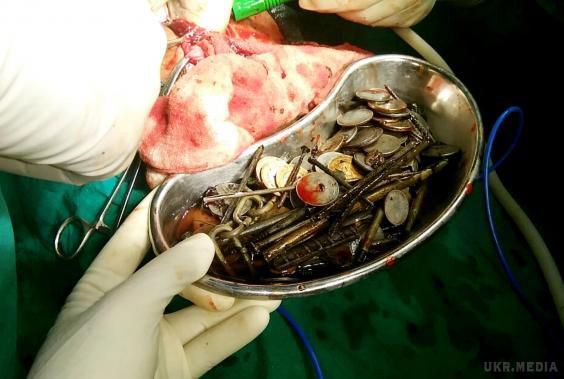 Хірурги в Індії витягли з пацієнта 7 кг заліза. Лікарі однієї з клінік в індійському місті Сатна дістали з пацієнта сім кілограмів сторонніх предметів.