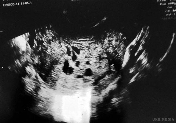 Жінка думала, що вона вагітна, але в підсумку буквально 'народила' ракову пухлину. Звучить неймовірно, але зараз ми все пояснимо.