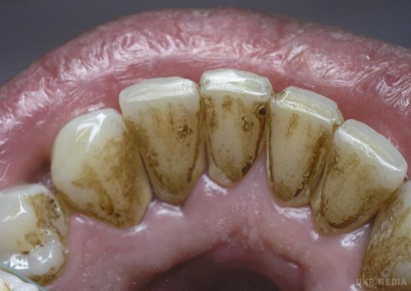 Прості способи легко видалити зубний камінь без візиту до зубного лікаря!. Якщо зубний камінь вже утворився, то пропонуємо вам 10 простих способів легко видалити його без відвідування стоматолога.