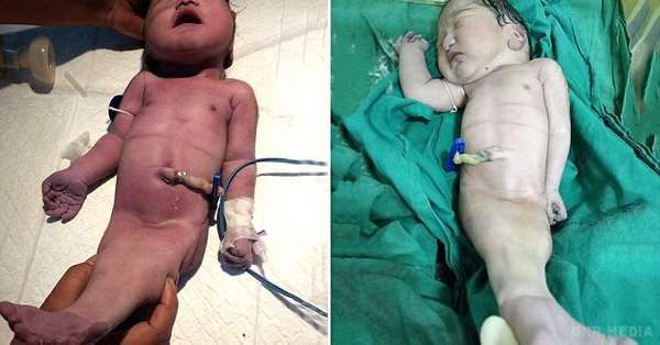 В Індії жінка народила дитину-русалку. Новонароджений помер через чотири години після появи на світло з-за аномалій розвитку.