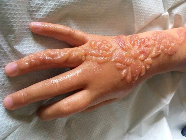 Рука дівчинки покрилася величезними пухирями після нанесення тимчасової тату хною в Єгипті. Чорна хна небезпечна.