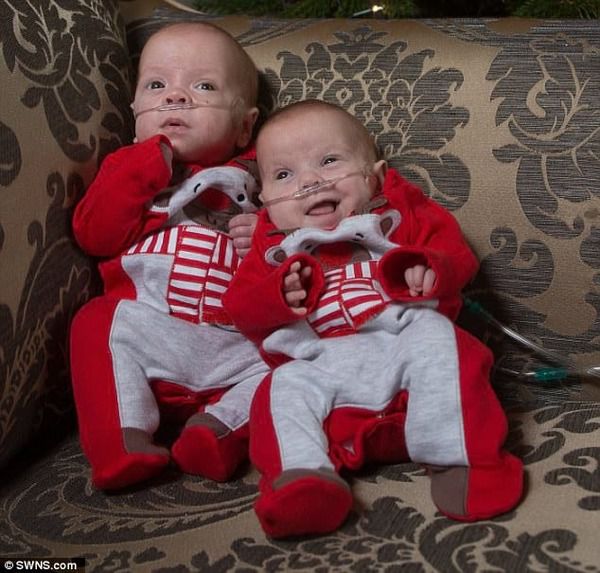 У Британії народилися самі маленькі близнюки в світі! (фото). У Британії народилися самі маленькі близнюки в світі! Коли ці малюки з'явилися на світ, то разом важили всього 1300 грам! Ава і Ісла народилися на 14 тижнів раніше, ніж повинні були. 