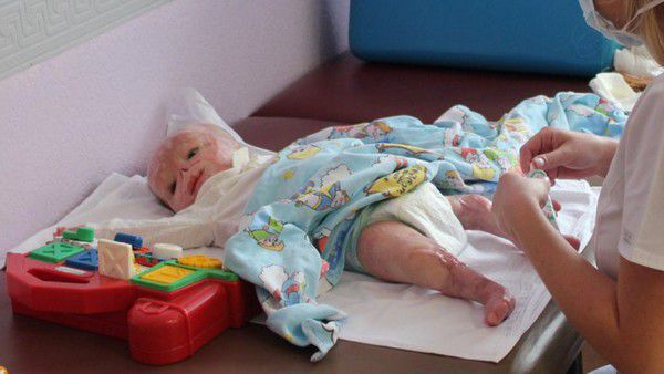 Новонародженого малюка віднесли на фототерапію. Медсестра накрила лампу і просто вийшла... Через 12 хвилин життя дитини змінилося назавжди. Ліва рука закінчується обрубком. На знівечених шрамами ногах — немає пальчиків.