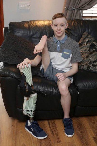 В Ірландії лікарі пришили підлітку ногу задом наперед. Для збереження життя і подальшого нерозповсюдження хвороби юнак був змушений позбутися частини ноги і носити протез.