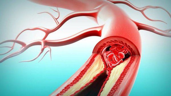 Німецькі кардіологи знають: найкращий засіб для чищення артерій лежить у вас на кухні!. 100% натур-продукт!