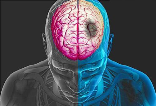 Небезпечна проблема, яка часто залишається непоміченою - "Тихий" інсульт. При "тихому" інсульті кровообіг порушується в тих відділах головного мозку, які не відповідають за вітальні функції (рух, мова).