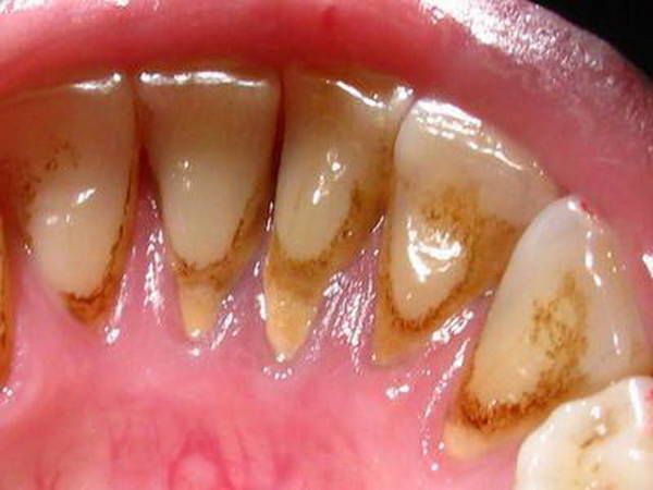 Ось як позбутися від зубного каменю без допомоги стоматолога. Спробуйте самі.