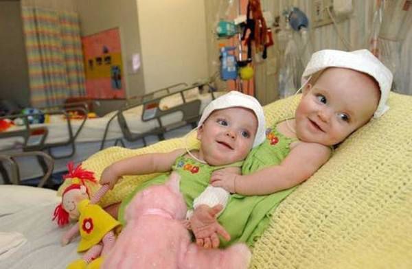 Сіамськи близнюки: цих крошок розділили у 9 місяців. Їм вже по 14 років! (фото). Зараз дівчаткам по 14 років. Як і інші підлітки, вони повні життя, енергії та завзяття.