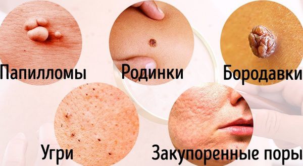 8 захворювань, про наявність яких нам підкаже шкіра(відео). Якщо ви помітили незрозумілі пупиришки.