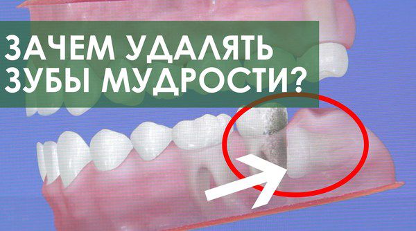 Чим небезпечне видалення зубів мудрості. Зазвичай зуби мудрості видаляють в тому випадку, коли вони доставляють занепокоєння. Але багатьох цікавить: а чи не небезпечно це?