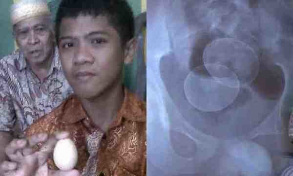 Індонезійський хлопчик заявив про свою здатність відкладати яйця (фото). 14-річний хлопчик з індонезійської провінції Південний Сулавесі заявив про свою здатність відкладати яйця. За словами Акмаля Руслі, за останні два роки він «зніс» двадцять яєць.