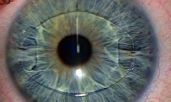 Вчені винайшли штучне око з керуванням та формою. Вчені вразили громадськість унікальним відкриттям. 
