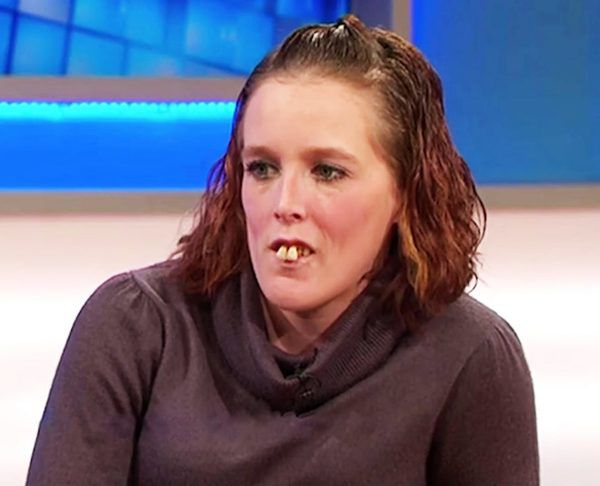 Над нею знущалися з-за її жахливих зубів. Подивіться яка вона стала зараз після операції у розмірі 10000 доларів. Коли Джеммі Свіфт було 6 років, вона з розмахом врізалася в стовп. Хоча з часом вона оговталася від нещасного випадку, але її зуби не відновилися.