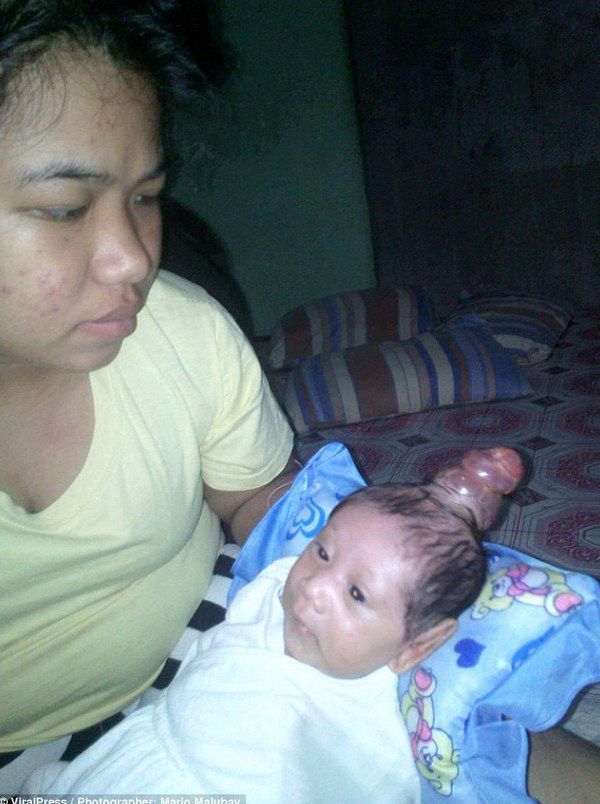 Філіпінка народила малюка схожого на єдинорога (фото). 20-річна Ангела Пуерто з Філіппін народила дитину з грижею на голові, з-за якої малюк схожий на єдинорога.