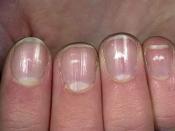 10 захворювань, які можна розпізнати за станом нігтів. Людський організм так влаштований, що при найменшому збої в роботі він дає нам сигнали.