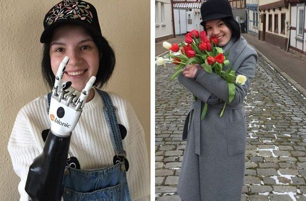 В Німеччині  поставила протез дівчині, якій чоловік відрубав кисті руки з ревнощів. У грудні минулого року 26-річний Дмитро Грачов  відрубав руки дружині, запідозривши її у зраді.