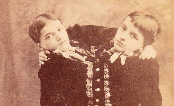 Неймовірні фото сіамських близнюків, про яких ви не знали (Фото). Протягом багатьох століть сіамські близнюки спантеличували лікарів і вчених.