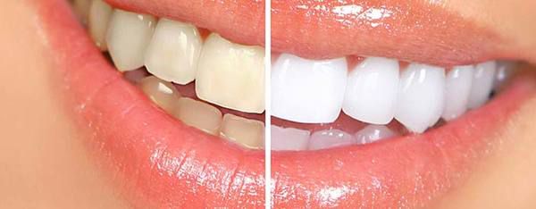 Як відбілити зуби в домашніх умовах -  ефективні і безпечні способи!. Білосніжна посмішка давно стала візитною карткою доглянутої жінки поряд з наманікюреними пальчиками.