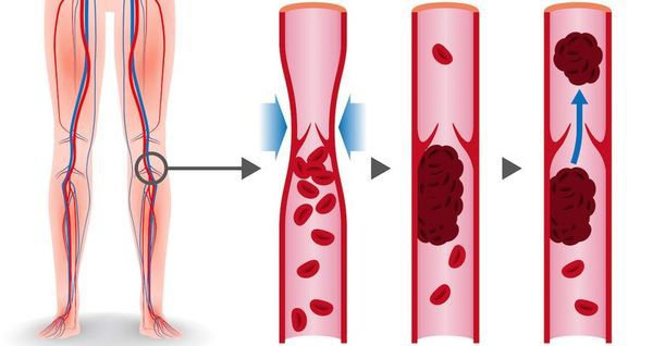 Продукти  для розрідження крові - як запобігти тромбозу. Дуже важливо підтримувати нормальну щільність крові, адже її надмірна густота може спровокувати серйозні порушення серцево-судинної системи.