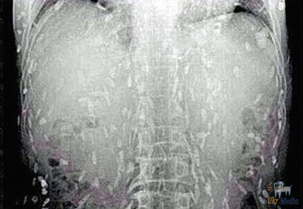 Коли лікарі побачили рентген цього хлопця, у них відвисла щелепа! Жахливе видовище!. Результат міг бути летальним.