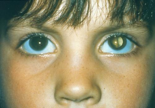 Вчені визначили причину вродженої катаракти у якутів. З розвитком сучасних методів досліджень вчені змогли визначити причину появи катаракти у якутів.