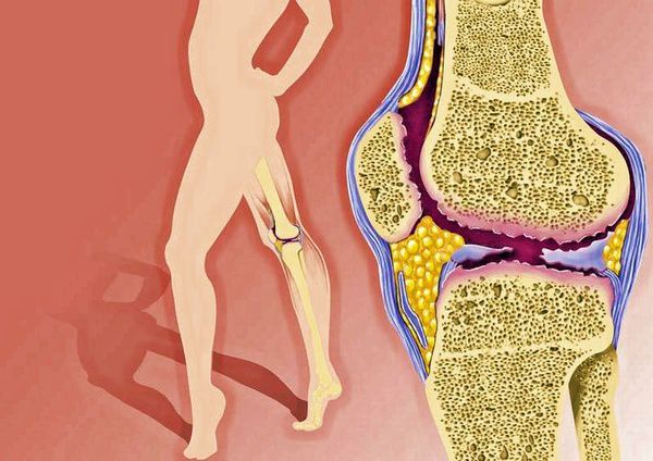 Як розпізнати перші симптоми остеоартриту. Хворі суглоби.