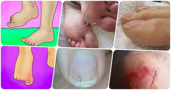 Як визначити хвороби по ступнях - в здоровому тілі здорові ноги!. Стан шкіри або нігтів наших кінцівок може багато що розповісти про здоров'я організму.