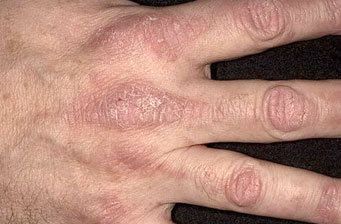 Руки допоможуть діагностувати 7 небезпечних захворюваннях. Частіше придивляйтеся до рук!