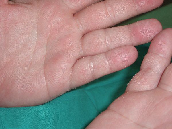 Руки допоможуть діагностувати 7 небезпечних захворюваннях. Частіше придивляйтеся до рук!
