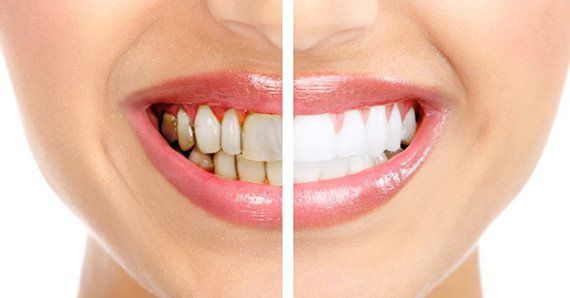 Ці суміші допоможуть усунути зубний камінь за 5 хвилин. Красиві зуби - красива усмішка.
