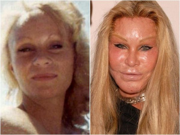 Як змінилися обличчя зірок до і після пластичних операцій. Деяких складно впізнати на ранніх фотографіях.