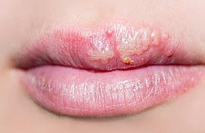 Основні симптоми герпесу на губах