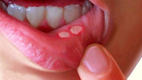 7 натуральних ліків, що допоможуь позбутись язв у роті. Можна швидко позбутись цієї неприємності.