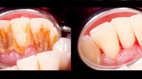 3 краплі — і зубний наліт зникне за один раз. Швидкий рецепт, як відбілити зуби.