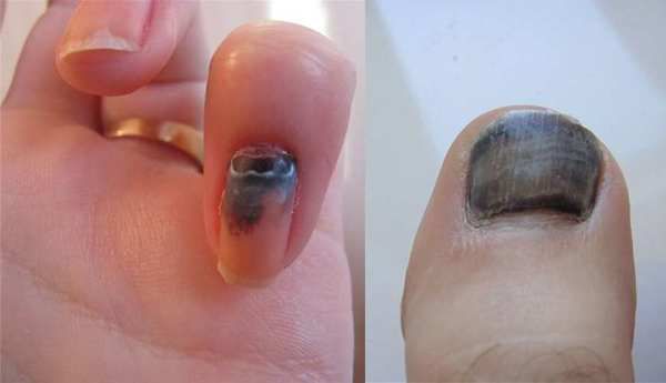 Як вилікувати почорніння нігтів після травми?. Виявляється ліки є і ви зможете відновити нігті.