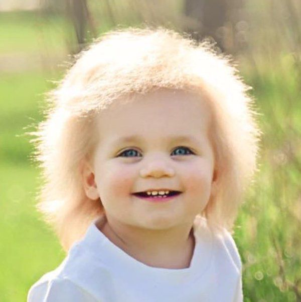 Це чудове дитя має синдром нерозчісуючогося волосся. І це рідкісна генетична причуда.