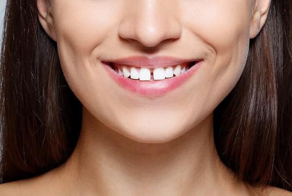 Чому з'являється щілина між зубами у дорослих?
