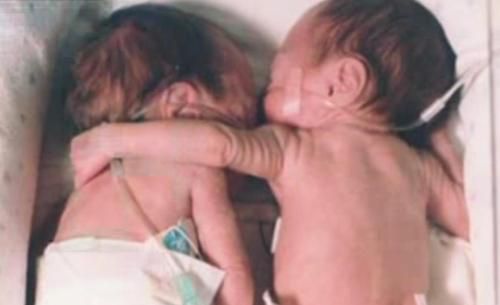 Диво сталося прямо на очах у лікарів, коли сестру-близнючку поклали поряд з хворою сестрою. Маленька рука Кірі спустилася на Бриель, і цей зворушливий момент став відомий у ЗМІ як «Рятівні обійми».