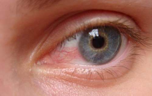 Червоні очі: як позбутися почервоніння за допомогою простих домашніх засобів. Червоні очі — це проблема, з якою стикається безліч людей. А неприємні відчуття і криваві очні білки можуть навіть налякати.
