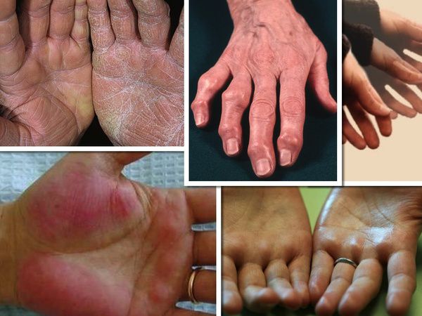 Як ваші руки сигналізують про проблеми зі здоров'ям. З віком перші проблеми зі здоров'ям можна діагностувати по стану ваших рук.