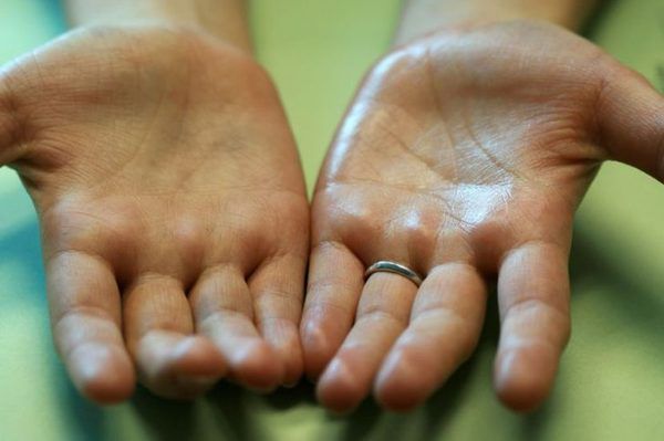 Як ваші руки сигналізують про проблеми зі здоров'ям. З віком перші проблеми зі здоров'ям можна діагностувати по стану ваших рук.