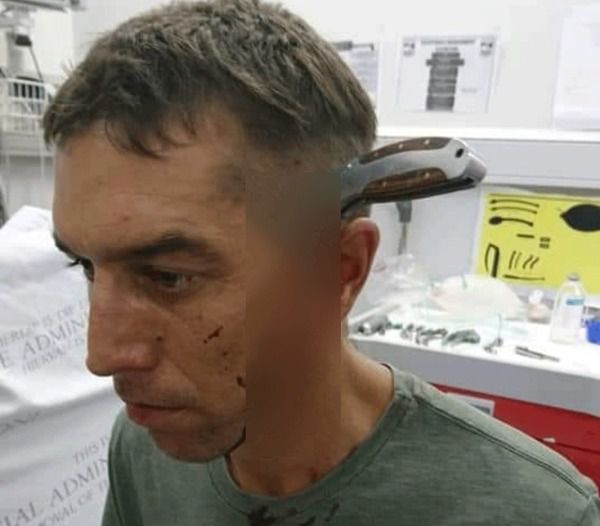 Велосипедист з ножем у голові відбився від злочинців і сам приїхав до лікаря. Лезо погнулося про череп і тому не проникло у мозок.