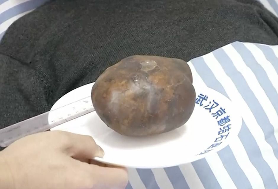 Жителю китайській провінції Ухань знадобилася термінова хірургічна операція, щоб видалити величезний камінь в сечовому міхурі. Камінь в сечовому міхурі китайця досяг розмірів страусиного яйця.