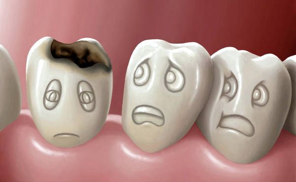 Карієс зубів - cимптоми хвороби, профілактика і лікування. Карієс — це захворювання зуба, при якому відбувається руйнування емалі та дентину, в результаті, на його поверхні утворюється пошкодження — «дірка».