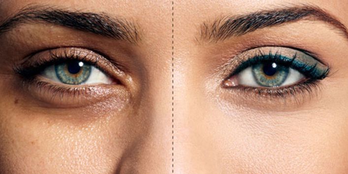 Метод, здатний позбавити від темних кіл під очима: татуаж повік. Нещодавно у Великобританії з'явилася процедура, що має всі шанси стати хітом в питанні позбавлення від темних кіл під очима.