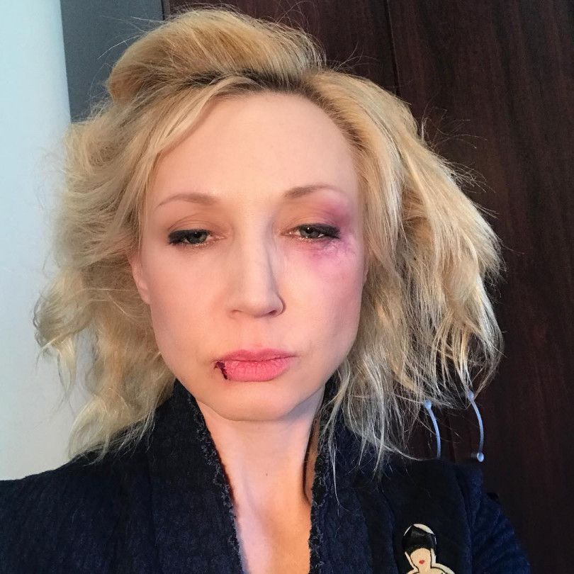 Крістіна Орбакайте поділилася фото, на якому у неї розбите обличчя. 