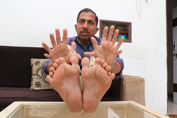 Індієць занесений в Книгу Рекордів Гіннеса через рекордні 28 пальців на руках і ногах. Нещодавно він був занесений в Книгу Рекордів Гіннеса за самого великого числа пальців у світі.