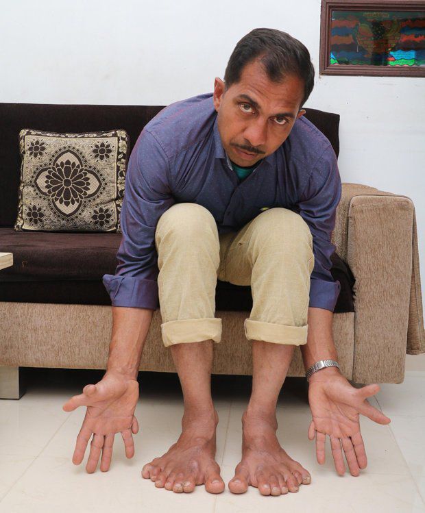 Індієць занесений в Книгу Рекордів Гіннеса через рекордні 28 пальців на руках і ногах. Нещодавно він був занесений в Книгу Рекордів Гіннеса за самого великого числа пальців у світі.
