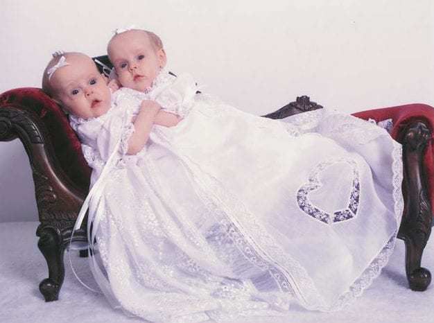 Сіамські близнюки, яких вдалося розділити ще у 2006 році. Зараз їм 17 років!. Медичне диво!